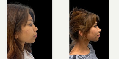25-34 year old woman treated with Asian Rhinoplasty, Rhinoplasty - Patient with a wide nose , bulbous tip and alar flaring. A rhinoplasty to narrow the nose has been performed . This has narrowed the the bridgeline, refined the nasal tip and reduced the nsotril flare. The result is only at 6 weeks. The scar on the basal view from under the nose is still slightly red at 6 weeks after surgery. This will fade over a few months.
