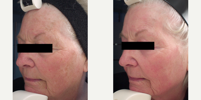 75 and up year old woman treated with Non-Ablative Laser Resurfacing, Photofacial, & Skincare - This patient was interested in improving the pigmentation, redness and texture of her skin. Her recommended treatment plan included a combination of medical-grade skin care and energy devices. We were able to help this client refresh her complexion by reducing the visibility of brown spots on the skin and minimizing her fine lines & wrinkles.
This was achieved with a series of Non-Ablative Fractional Resurfacing, Photofacial and microdermabrasion treatments. Her results are being maintained with medical-grade skincare and maintenance Photofacial and microdermabrasion treatments.