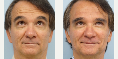 55-64 year old man treated with Restylane Silk - Botox is injected around the eyes and forehead. Restylane silk is also used as facial fillers to the deep horizontal forehead wrinkles. Radiesse is used for around the mouth into the laugh lines and marionette lines. He is satisfied with this rejuvenated look.