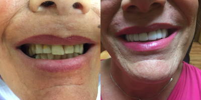 45-54 year old woman treated with Porcelain Veneers in only 2 appointments - This beautiful patient presented with stained and misaligned teeth. One of the front, center, top teeth was protruding and the other teeth had permanent yellow staining. This patient wanted a more feminine look to match her previously masculine teeth. Dr. Thompson created this patient's new smile with a focus on giving her teeth a bright white, but softer and rounder appearance.