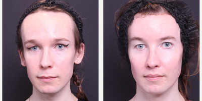 25-34 year old transgender woman treated with Facial Feminization Surgery - hairline advancement, brow lift, brow bone reduction, lip lift, upper and lower lip augmentation, cheek augmentation (BSM-L)