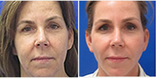 35-44 year old woman treated with Facelift - Patient felt that her sundamage etc made her skin look dull.
