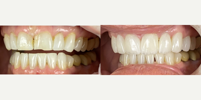 55-64 year old woman treated with Da Vinci Veneers, Porcelain Veneers - Female patient wanted to change her smile a while ago, she was hesitant to make the decision, but after a comprehensive dental evaluation and a digital smile design visit, we were able to listen to her concerns and her expectations, we built a couple of proposals and she decided to start the process of her new smile. She wanted to replace old composite restorations that were stained and chipped, and she also had loss of enamel due to wear. We restore her smile with minimally-invasive veneers, and hand crafted veneers (Da Vinci Veneers) by our ceramist. She absolutely loved the results and she is very happy and confident to smile again!.