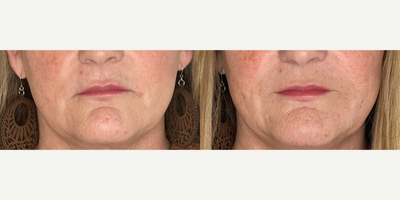 55-64 year old woman treated with Juvederm - Juvederm Ultra to lift the corners of the mouth and smooth marionette lines.