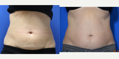 45-54 year old woman treated with SculpSure - 6 weeks after one treatment