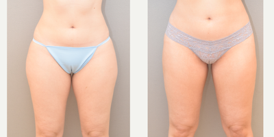 35-44 year old woman treated with SAFELipo - 39 yo s/p liposuction inner and outer thighs performed under local anesthesia with sedation in our on site certified operating suite.