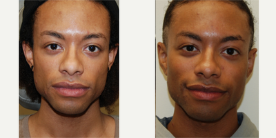 25-34 year old man treated with Silikon 1000 for permanent cheek augmentation - You can see natural looking cheek augmentation in our lovely patient following four treatments with Silikon-1000 - an off-label filler for permanent results. Thank you.