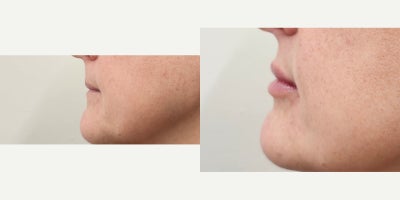 45-54 year old woman treated with Lip Fillers, Revanesse, Restylane - Needed Lip Renaissance with natural results