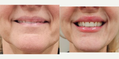 45-54 year old woman treated with Lip Fillers, Revanesse, Restylane - Needed Lip Renaissance with natural results