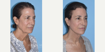 Woman treated with Lip Lift - Woman treated with Facelift, Neck Lift, Brow Lift, Eyelid Surgery, and Lip Lift