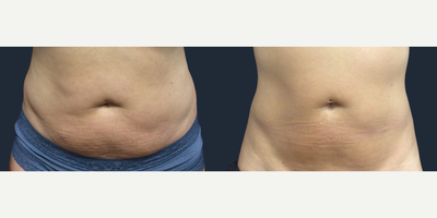 Woman treated with truBody - Woman treated with truBody
