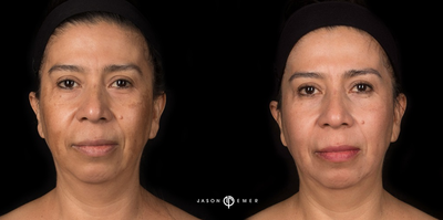 35-44 year old woman treated with Cosmelan - This is a woman in her 40s, three weeks post op after Cosmelan and Clear+Brilliant Laser.