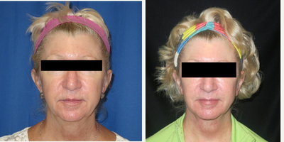 55-64 year old woman treated with Face and Neck Lift with Fat Grafting - Patient had a full face and neck lift with facial fat grafting.