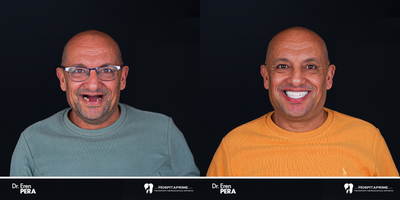 45-54 year old man treated with Dental Implants - .Dental Implants