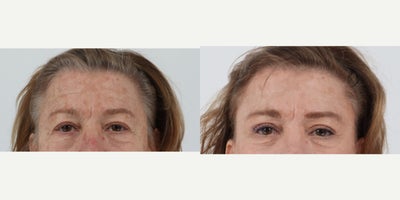 65-74 year old woman treated with Facelift, Neck Lift, Brow Lift, Eyelid Surgery, Lip Lift, CO2 Laser - 69 year old 2 months after facelift, neck lift, brow lift, upper and lower blepharoplasty, lip lift, co2 laser.