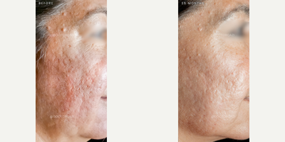 Acne Scars Combination Treatment - This patient did a combination treatment with Subcision, CO2 Laser and RF Microneedling.