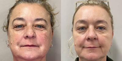 57 year old woman treated with 3 treatments of IPL - To address the concerns of this lovely patient's sun spots we treated her with three rounds of IPL, to a significant improvement in an even skin complexion and texture!