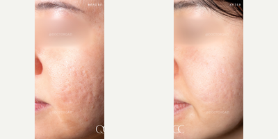 Acne Scars Combination Treatment with TCA Cross + Subcision + CO2 Laser. - Patient did an acne scars combination treatment with TCA Cross + Subcision + CO2 Laser.