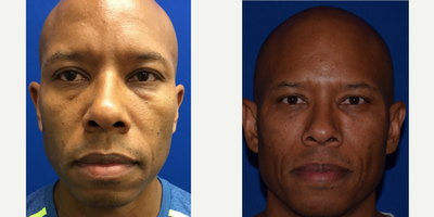 45-54 year old man treated with Restylane Lyft - This patient was bothered by lower eye bags and looking old. Dr. Robb Jr. performed filler to the under eyes and cheeks to create a natural and rested appearance.