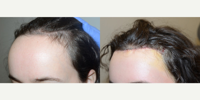 25-34 year old woman treated with Forehead Reduction - Before and just one week after hairline lowering/forehead reduction surgery.Despite this patient having only limited (fair to fairly good) scalp laxity, a full inch of forehead reduction was able to be achieved.