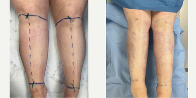 35-44 year old woman treated with Lipedema Surgery, Liposuction - Immediate on the table post-op results from circumferential Lipedema Liposuction on this Stage 3 patient's calves and ankles.