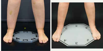 25-34 year old woman treated with Lipedema Surgery, Liposuction - 1-month post-op results from circumferential Lipedema Liposuction on this Stage 2 patient's calves and ankles.