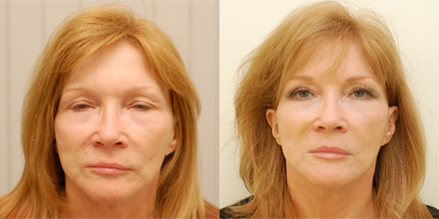 55-64 year old woman treated with Silhouette Soft - This patient had previously had a facelift 10 years earlier but had noticed laxity occurring again along the jawline and jowls. She didn't want to have further surgery and elected to have Silhouette Soft achieving an excellent result with minimal downtime.You can see the lift of her mid-face and cheeks which helps support and restore a natural shape back to her lips as well.