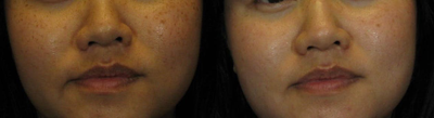 Woman treated with Laser Peel - Woman treated with Laser Peel