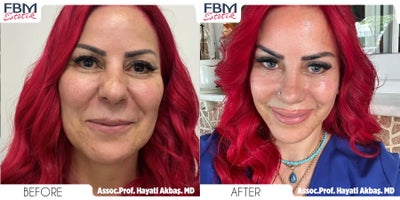 45-54 year old woman treated with Deep Plane Facelift, Mini Neck Lift, Facial Fat Transfer, Eyelid Surgery - 45-54 year old woman treated with Deep Plane Facelift, Mini Neck Lift, Facial Fat Transfer, Eyelid Surgery
