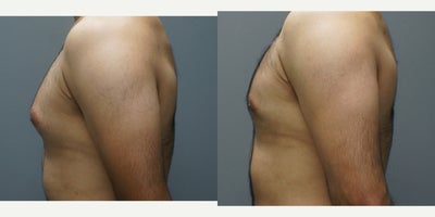 25-34 year old man treated with Male Breast Reduction - This patient presented with fullness in the breasts due to male-pattern breast tissue. Dr. Davison's peri-areolar excision technique gave the patient his confidence back without giving an overly-done, sunken look to the chest or any perceptible scars.