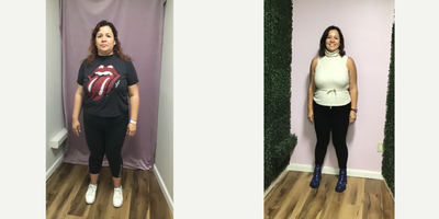 45-54 year old woman treated with Endoscopic Sleeve Gastroplasty - She lost 37 Lbs in 4 months after her Endoscopic Sleeve Gastroplasty procedure.