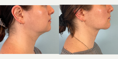 Woman treated with Buccal Fat Removal, Jawline Sculpting, Chin Implant - Woman treated with Buccal Fat Removal, Jawline Sculpting, Chin Implant