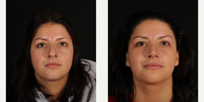 18-24 year old woman treated with Rhinoplasty - Our beautiful patient just came back to #kansascity for her 6 week visit after her #rhinoplasty and is healing beautifully. Thanks to her for letting us share. We brought the bridge down and rotated & contoured her tip with cartilage grafting.