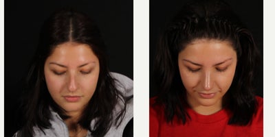18-24 year old woman treated with Rhinoplasty - Our beautiful patient just came back to #kansascity for her 6 week visit after her #rhinoplasty and is healing beautifully. Thanks to her for letting us share. We brought the bridge down and rotated & contoured her tip with cartilage grafting.