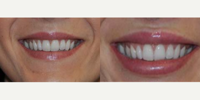 25-34 year old woman treated with Lip Implants - Permanent Lip Augmentation - 28 years old5mm Perma Facial implants upper and lower