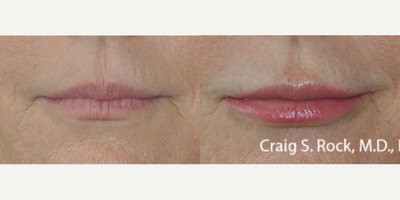55-64 year old woman treated with Lip Implants - Permanent Lip Augmentation 55 years old5mm Perma Facial implants upper and lower