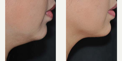35-44 year old woman treated with truSculpt - truSculptiD Treatment area: under the chinNumber of treatments: 4 (spaced 4 weeks apart)42 years old, 5'4 tall, 125 lbFat pinch thickness: pre-treatment - 21mm post-treatment - 9mm (57% reduction)