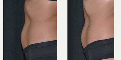 25-34 year old woman treated with truSculpt - truSculptiD Treatment area: lower abdomenNumber of treatments: 129 years old, 5'9 tall, 137 lbFat pinch thickness: pre-treatment - 40mm post-treatment - 26mm (35% reduction)