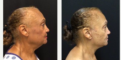 65-74 year old woman treated with MACS Facelift - MACS Face Lift