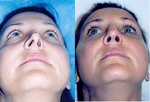 25-34 year old woman treated with Revision Rhinoplasty - This is a 32 year old patient that had rhinoplasty at a different practice 10 years prior. She was unhappy with the general appearance and the long length of the tip.