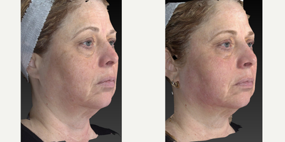 45-54 year old woman treated with Skin Tightening using our Tyte and Bryte protocol - These are great results using a technique that is offered exclusively here at Kovak Cosmetic Center. It is a combination of light therapy and resurfacing techniques. Notice the age marks and skin tightening of the neck skin.