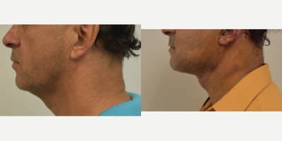 55-64 year old man treated with Neck Lift - Neck and mini facelift. Still healing but looking good.&nbsp;I post this at 2 wks so that patients are able to appreciate how much swelling and bruising can still be present. It is important&nbsp;to appreciate this prior to undergoing such a procedure.