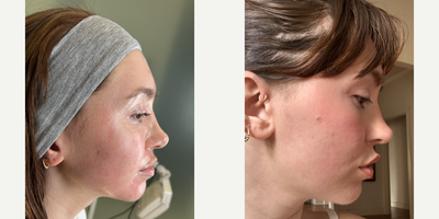 SELFIE SCARS | ACNE COMBO - Our patient has some very deep acne scars that have hurt her confidence for a long time, so she's ready to get rid of them. We did a combination treatment of punch excisions, Halo and CO2 lasers, PDO After Goo, and of course our favorite- the Emer Skin Hydration mask. Combining all of these treatments are not only going to help stimulate collagen reproduction but also help soften her acne scars as well as her skin's overall texture. Needless to say, she could not be happier with her results and is loving her smooth and rejuvenated skin.PUNCH EXCISIONHALO LASERCO2 LASERPDO AFTER GLOEMER SKIN HYDRATION MASKNo treatment is complete without EMER SKIN. Using our products post-treatment will enhance results to the absolute maximum. Click Link in Bio Click Emer Skin