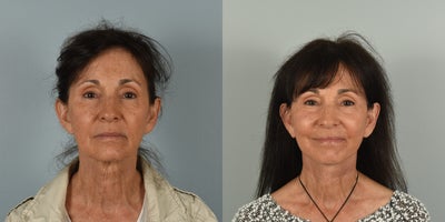 65-74 year old woman treated with Facelift - 68 year old female who underwent Facelift, Neck Lift, CO2 laser resurfacing and fat grafting 3 months ago.