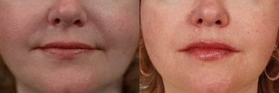  51 year old woman treated with Restylane - Restylane to lips