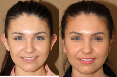 Otoplasty - 
	Ear surgery - otoplasty usually performed under local anesthesia
