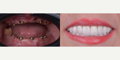 55-64 year old woman treated with All-on-4 Dental Implants, Dental Implants, Full Mouth Reconstruction, Smile Makeover, Six Mont - upper and bottom All on 6, Zirconia overdenture with 6 dental implants on top and 6 bottom.