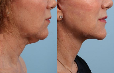 Woman treated with Facelift - Woman treated with Facelift