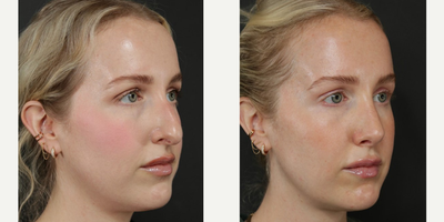 Woman treated with Rhinoplasty - Woman treated with Rhinoplasty