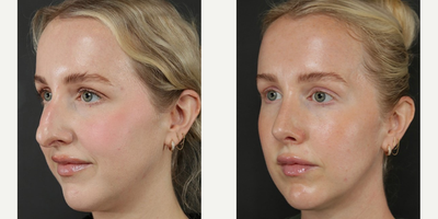 Woman treated with Rhinoplasty - Woman treated with Rhinoplasty